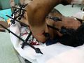 Поредна уникална операция в Русе: Лекари извадиха метална ограда от ръката на мъж
