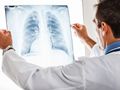 Белодробната болница започва безплатни прегледи за туберкулоза