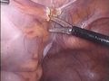 Първа безкръвна операция на тумор на дебелото черво в болницата