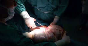 Д-р Георги Хубчев избави жена от 15-килограмов злокачествен тумор