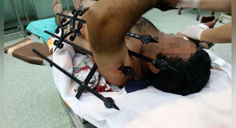 Поредна уникална операция в Русе: Лекари извадиха метална ограда от ръката на мъж