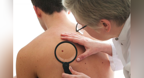 Какво е меланомът и какви са ранните признаци на рака на кожата?