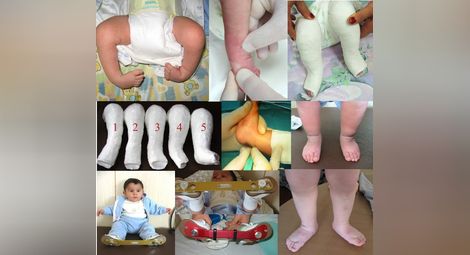 Д-р Боян Валентинов: Вродените ортопедични малформации не са присъда