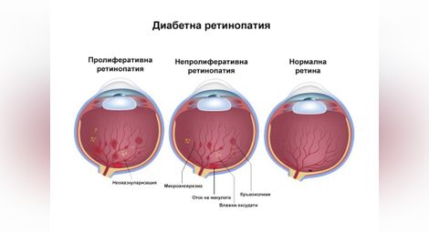 Д-р Магдалена Младенова: Нелекуваната диабетна ретинопатия води до прогресивно намаление на зрението