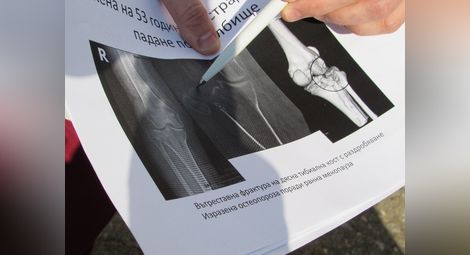 Спасиха раздробено коляно в „Канев“ с неприлаган досега метод в България