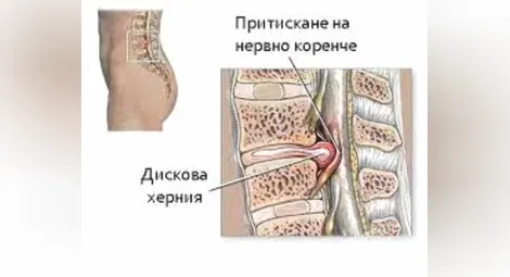 Доц. Славомир Кондов: Лумбалната дискова херния е сред най-честите причини за болка в кръста