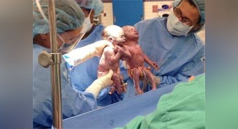 Близнаци се родиха хванати за ръце /видео/