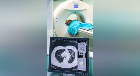 Изкуствен интелект открива рак на белия дроб в „Канев“, докато е напълно лечим