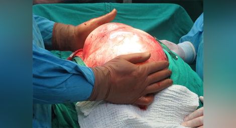 Хирурзи отстраниха огромна 9-килограмова киста от яйчника на жена