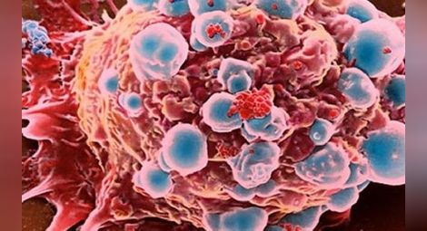 Американците признаха: Химиотерапията не лекува рака
