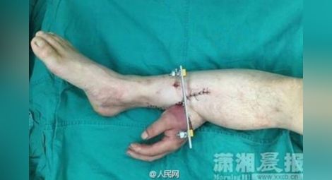 Хирурзи спасиха ръка като я присадиха към крак