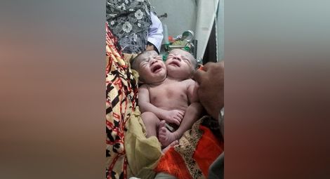 Бебе с две глави се роди в Бангладеш