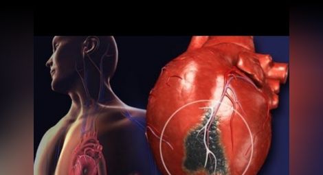 По какво се различава сърдечен пристъп, инфаркт и инсулт: Признаци
